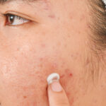 acne antibiotics side effects