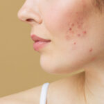 acne aestivalis treatment