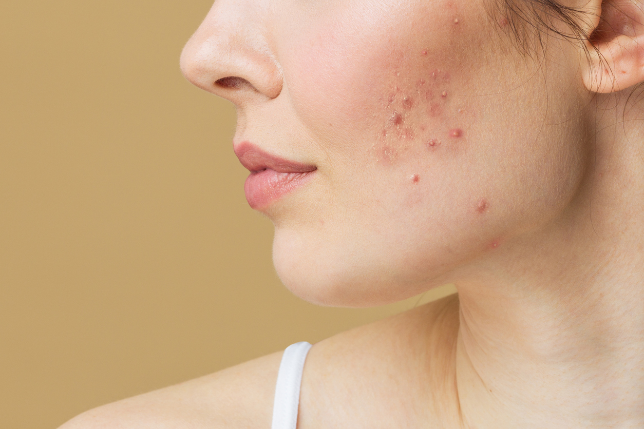 acne aestivalis treatment